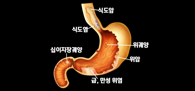 위 내시경으로 진단할 수 있는 질환